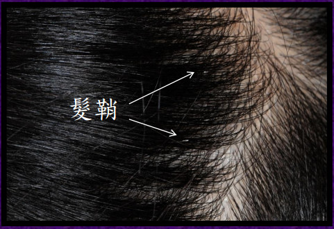 頭發(fā)上有管狀附著物怎么去除 發(fā)鞘是什么