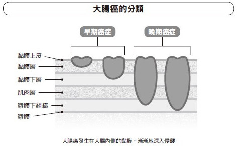 大腸癌的早期癥狀與病程 生活習(xí)慣是預(yù)防關(guān)鍵