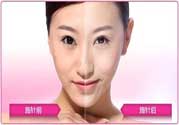 美白針真的有效嗎？美白針的危害有哪些？