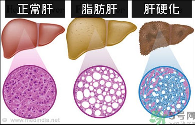 得了脂肪肝該怎么治？脂肪肝對人體危害有多大？