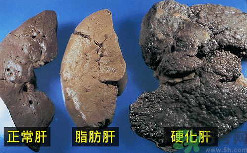 得了脂肪肝該怎么治？脂肪肝對人體危害有多大？