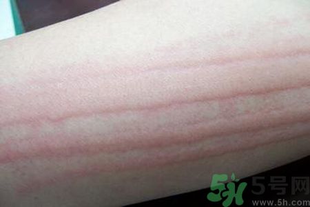 蕁麻疹會不會傳染？蕁麻疹怎么治才能好？
