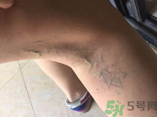 40歲女性小腿靜脈曲張?jiān)趺崔k？