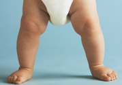 孩子一個腿長一個腿短是什么??？孩子長短腿怎么辦？