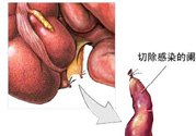 闌尾手術(shù)會影響結(jié)腸嗎？闌尾手術(shù)術(shù)后要注意什么？