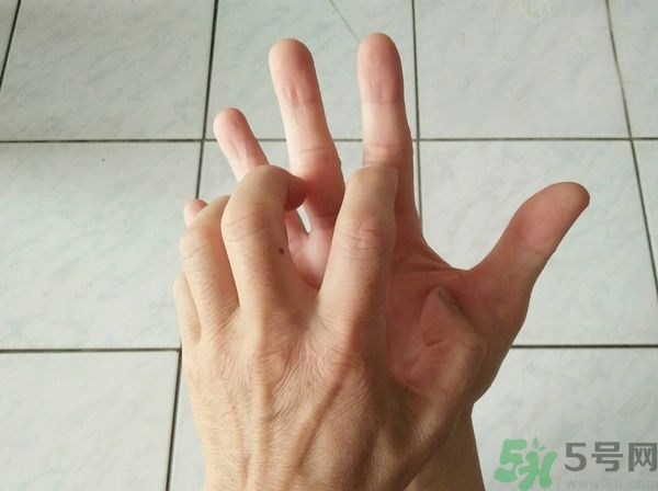 手上起水泡是什么原因？怎樣預防手上起水泡？