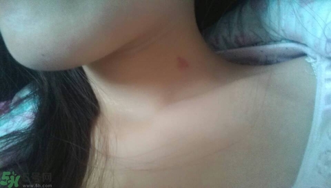 種草莓吻痕是什么意思？吻痕是怎么弄出來的？