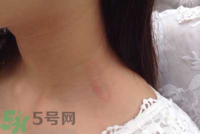 種草莓吻痕是什么意思？吻痕是怎么弄出來的？