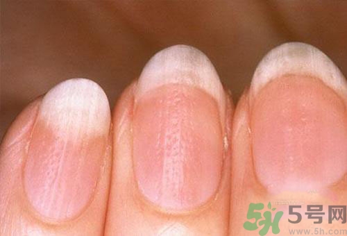指甲發(fā)白是怎么回事？指甲發(fā)白代表什么？