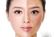 激光美白有用嗎？激光美白可以維持多久？