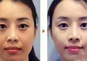 激光美白多少錢？激光美白價格