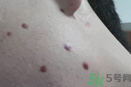 激光點(diǎn)痣后可以洗臉嗎？激光點(diǎn)痣后需要注意什么？