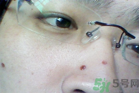 激光點(diǎn)痣后可以洗臉嗎？激光點(diǎn)痣后需要注意什么？