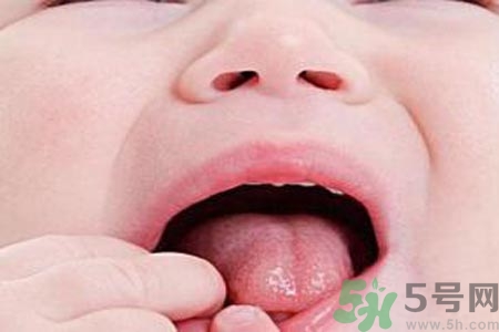 寶寶口腔潰瘍怎么辦？治療寶寶口腔潰瘍方法有什么？