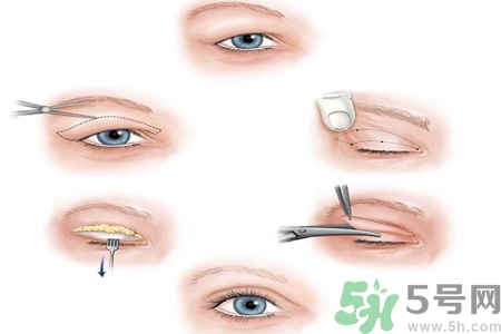 割雙眼皮分哪幾種？割雙眼皮需要多少錢？