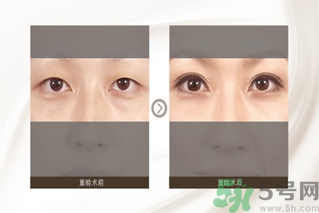 割雙眼皮分哪幾種？割雙眼皮需要多少錢？