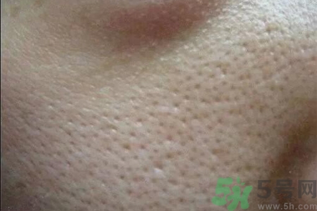 皮膚毛孔粗大原因有哪些？如何預(yù)防皮膚毛孔粗大？