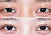 割雙眼皮分哪幾種？割雙眼皮需要多少錢？