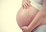 什么是妊娠紋？妊娠紋什么時(shí)候開(kāi)始長(zhǎng)？