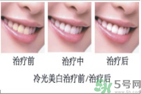 冷光美白牙齒是什么？冷光美白牙齒的好處有哪些？