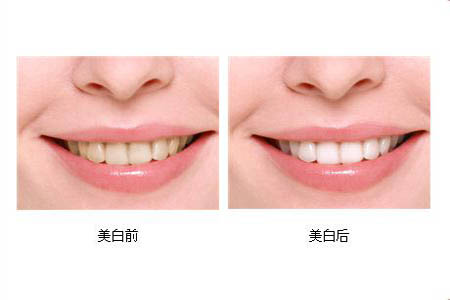 冷光美白牙齒可以保持多長時間？冷光美白牙齒有副作用嗎？