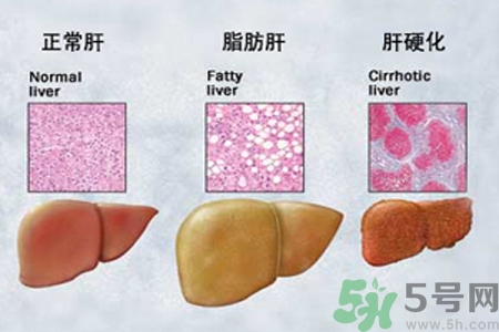 妊娠急性脂肪肝是什么？妊娠急性脂肪肝的治療方法？