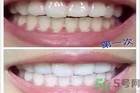 冷光美白牙齒的價(jià)格是多少？做冷光美白牙齒需要多少錢(qián)？