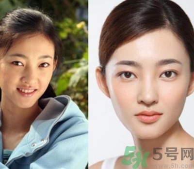 開眼角眼睛會變大嗎？開眼角眼睛能大多少？