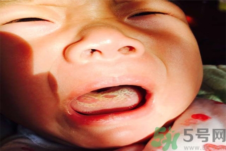 舌頭燙傷后該怎么辦呢？舌頭燙傷后應(yīng)該注意吃什么？?