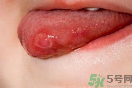 舌頭長泡怎么辦？舌頭長泡的原因？