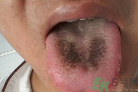 舌頭發(fā)黑怎么回事？舌頭發(fā)黑怎么辦？