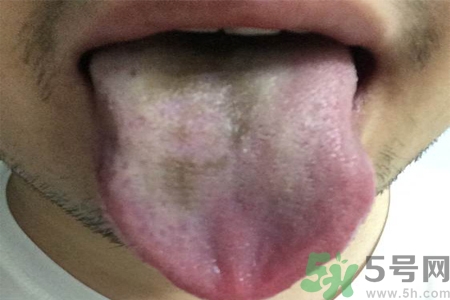 舌頭發(fā)黑怎么回事？舌頭發(fā)黑怎么辦？