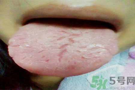 舌頭上有裂紋是怎么辦？舌頭上有裂紋是什么原因？