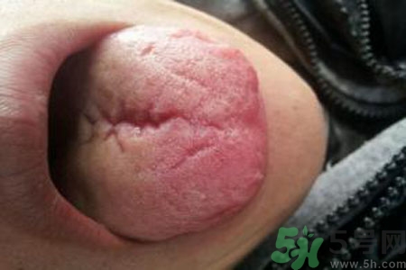 舌頭上有裂紋是怎么辦？舌頭上有裂紋是什么原因？