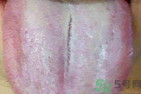 舌頭發(fā)白是什么原因？舌苔發(fā)白是怎么辦？