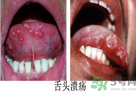 舌頭潰瘍怎么辦？舌頭潰瘍的原因？