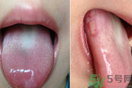 舌頭潰瘍怎么辦？舌頭潰瘍的原因？