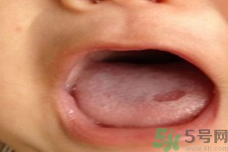 舌頭潰瘍怎么辦？舌頭潰瘍的原因？