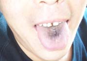 舌頭發(fā)黑怎么回事？舌頭發(fā)黑怎么辦？