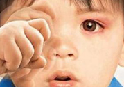 寶寶得了紅眼病怎么辦？寶寶得了紅眼病怎么治？