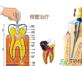什么是根管治療？為什么牙齒疼要做根管治療？