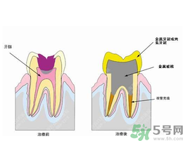 什么是根管治療？為什么牙齒疼要做根管治療？