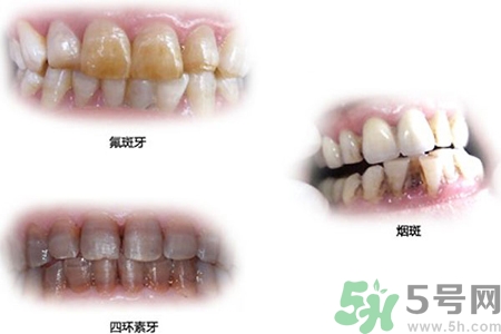 四環(huán)素牙是什么？四環(huán)素牙是怎么形成的？