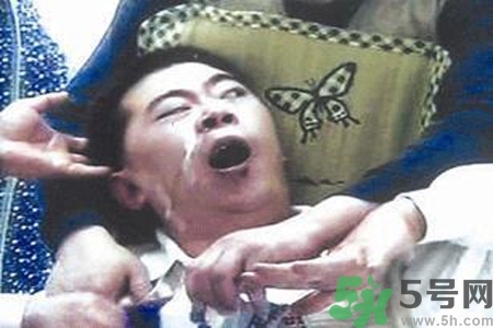 癲癇的典型癥狀有哪些？癲癇是什么？