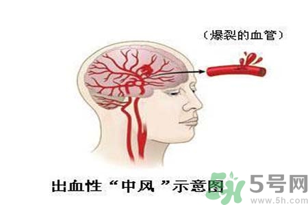 腦中風(fēng)的護(hù)理措施？腦中風(fēng)的飲食護(hù)理？
