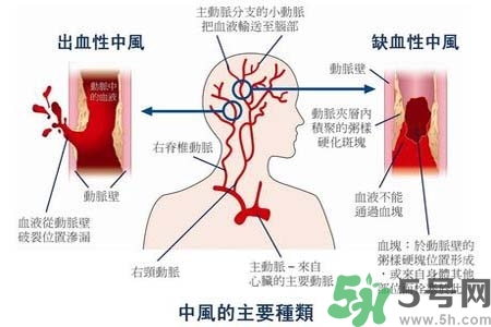 腦中風(fēng)的發(fā)病因素？腦中風(fēng)的并發(fā)癥有哪些 ？