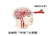 腦中風(fēng)的發(fā)病因素？腦中風(fēng)的并發(fā)癥有哪些 ？