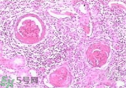 慢性腎炎能治好嗎？慢性腎炎能活多久？