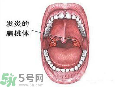 慢性咽炎是什么？慢性咽炎的癥狀有哪些？