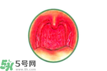 慢性咽炎的治療方法？慢性咽炎的藥物治療？